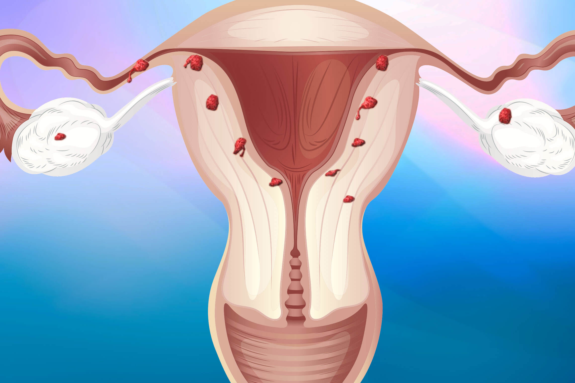 Препарат для лечения эндометриоза матки