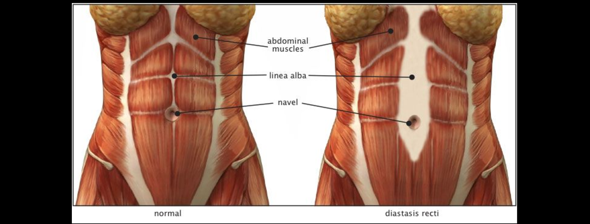 Причины появления диастаза прямых мышц живота