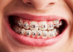 Брекеты у взрослых: исправление прикуса и улучшению эстетики улыбки на любом этапе жизни
