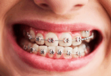 Брекеты у взрослых: исправление прикуса и улучшению эстетики улыбки на любом этапе жизни
